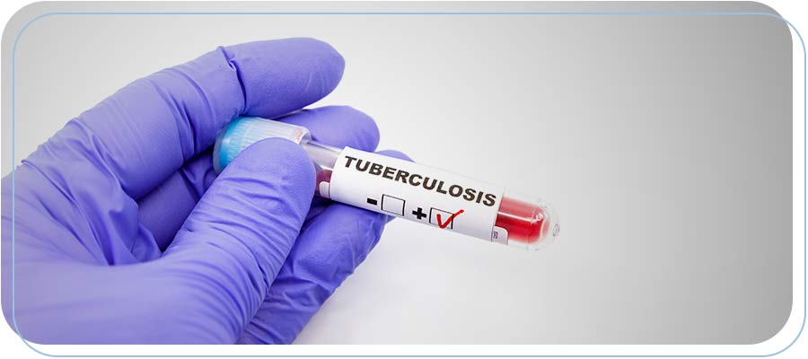 Tuberculosis Testing Near Me | Convenient Location to Serve You